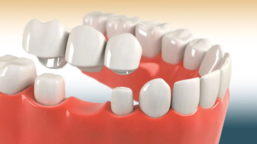 Crowns and bridges in lucknow, Best dentures in lucknow, Best maxillofacial surgeon in lucknow, Best dentist in Lucknow, dentist in Lucknow
